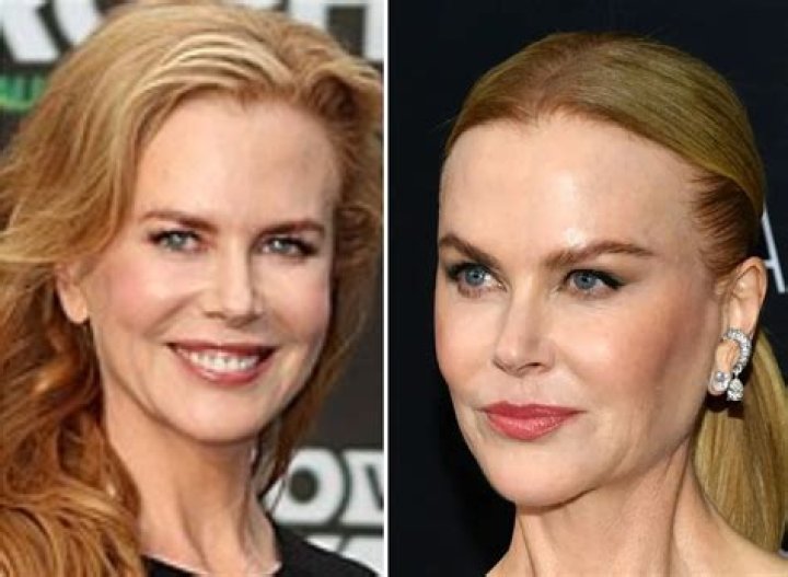 The Evolution Of Nicole Kidman: Before And After Plastic Surgery